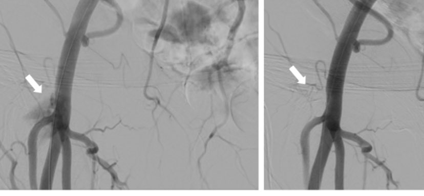 BURZOTTA_F's tweet image. If you are looking for adding surgical techniques to #ProGlide closure, have a look on our ‘PLEDGET-ASSISTED HAEMOSTASIS’ to fix failures! It was really a game changer for our less-invasive totally-endovascular (LITE) #TAVI / #TAVR programme!!! dx.doi.org/10.4330/wjc.v1…