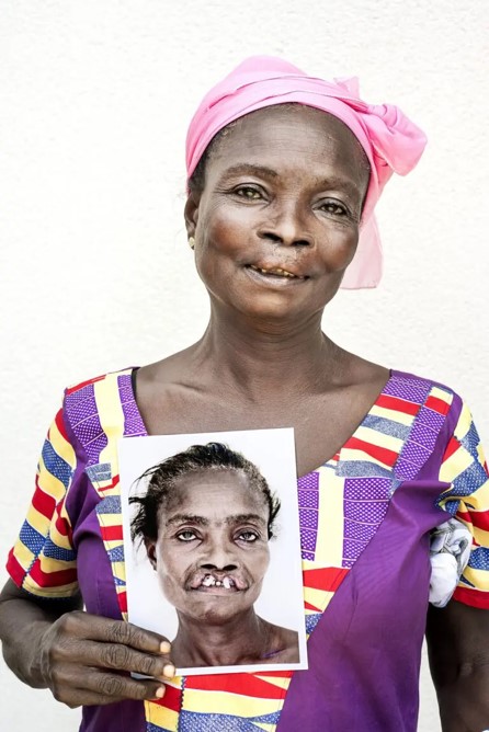 OpSmileUK's tweet photo. Can you imagine living more than half your life with an untreated #CleftCondition? Akosua was 52 before she found Operation Smile Ghana &amp; had her life-changing cleft surgery - now she’s made it her mission to make sure no one else has to wait so long for help. #SharingSmiles https://t.co/OtORc6POLY