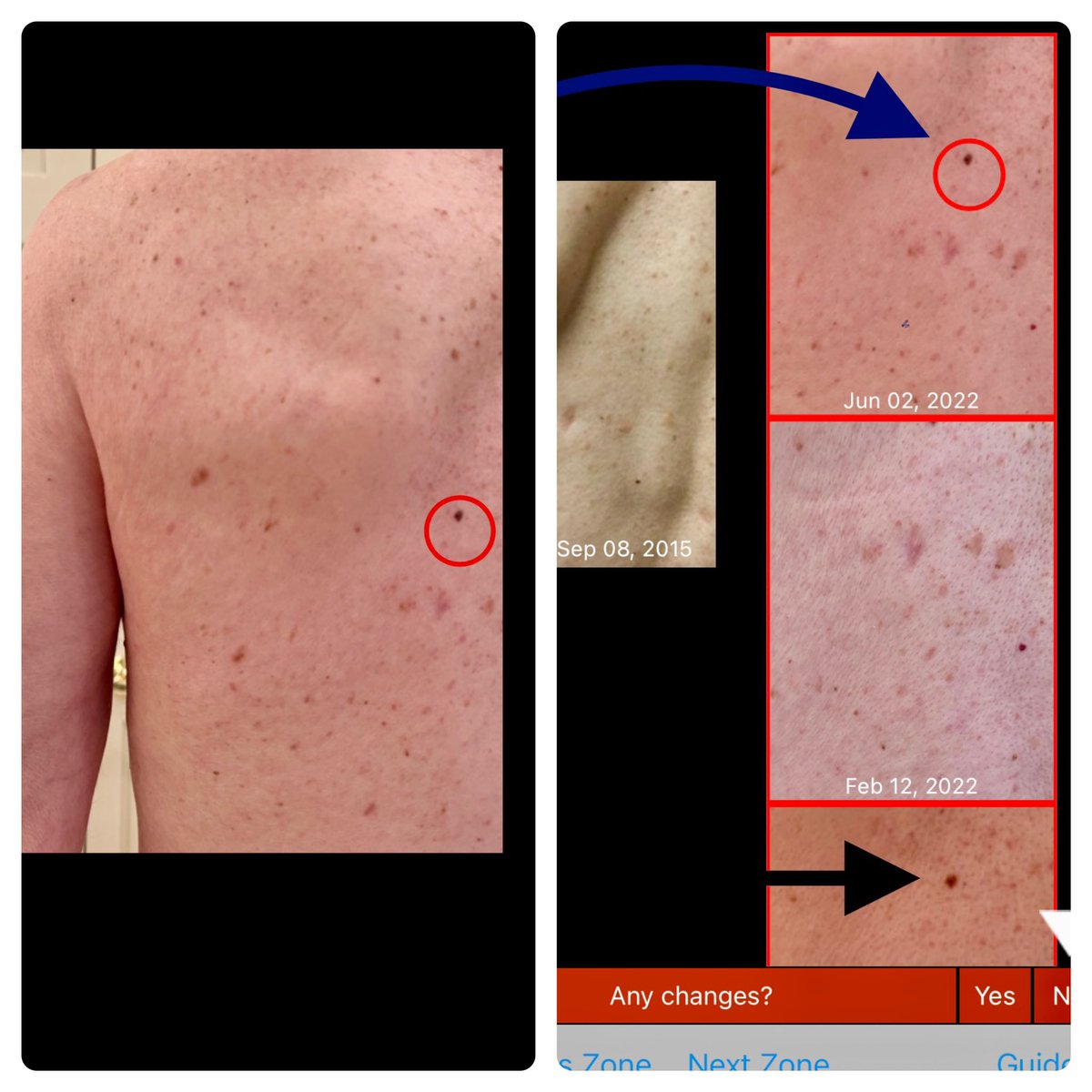 Tracking &amp; comparing moles for  change with photos can directly impact your health. Check yourself. Check your partner. Get checked. Take pictures.
#Melanoma #skincancer