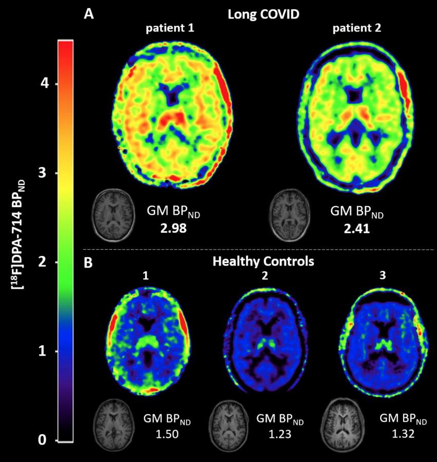 IanJBD's tweet photo. https://t.co/yHphabNh21

Widespread inflammatory activity in the brain &amp; mainly in the brain stem in patients with #LongCovid 

Long COVID is associated with extensive in-vivo neuroinflammation on [18F]DPA-714 PET

Ie: encephalitis, NOT functional disorders https://t.co/8kqVDNJSUF