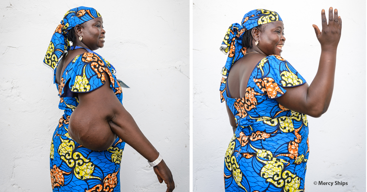 Since she was a young girl, Fanta saw nurses at her local hospital in their uniforms taking care of people, and she knew she wanted to be a nurse, too. But, the watermelon-sized tumor meant she couldn’t fit her arm through the sleeve of her uniform. Now, she can wear it.