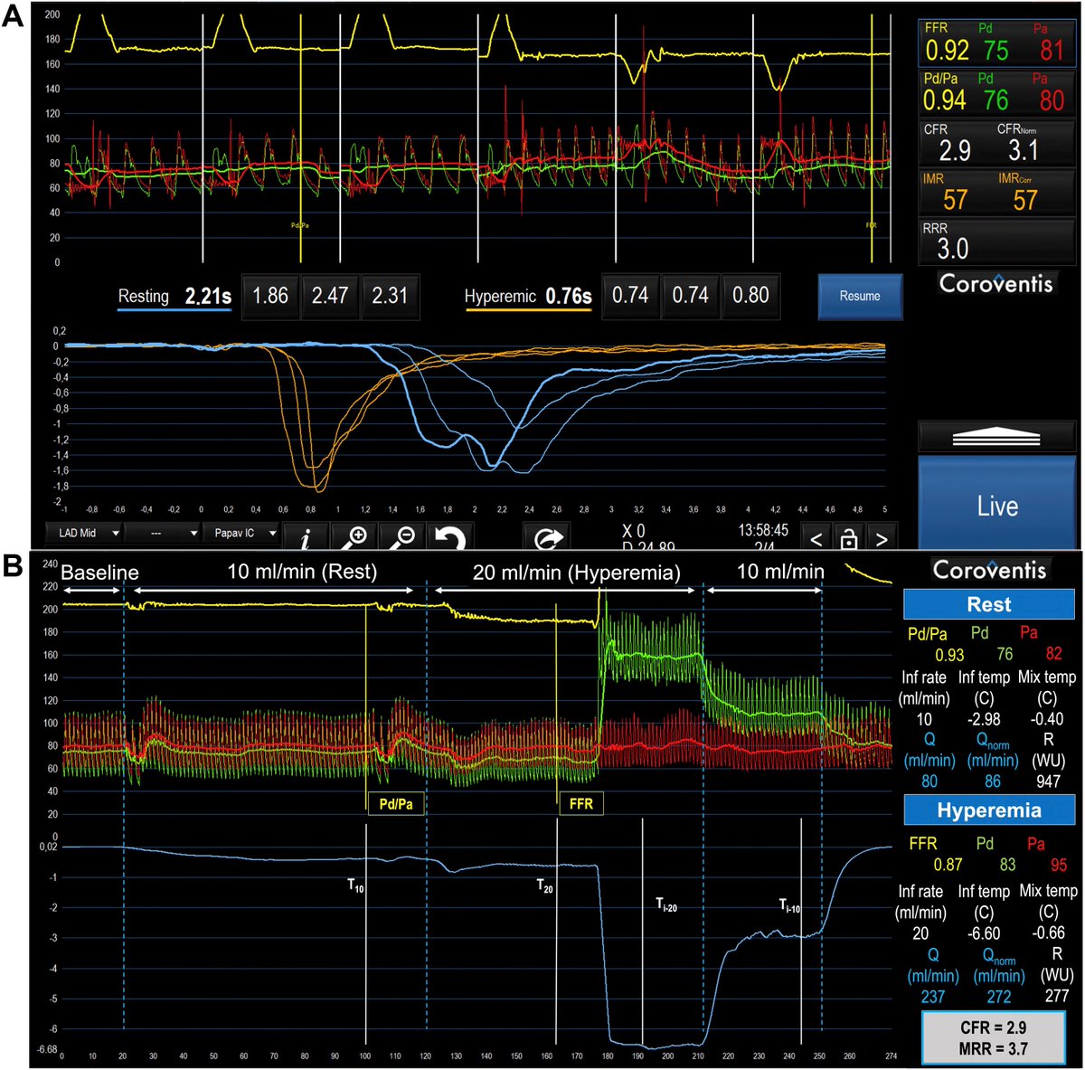 JACCJournals's tweet image. Coronary slow flow is not always equal to low flow and high microvascular resistance!

Read #JACCINT to learn what to do in this clinical scenario: bit.ly/3xfK2IZ

#IMR #SlowFLow #CardioTwitter @BernardBruyne @EGallinoro @P_Paolisso