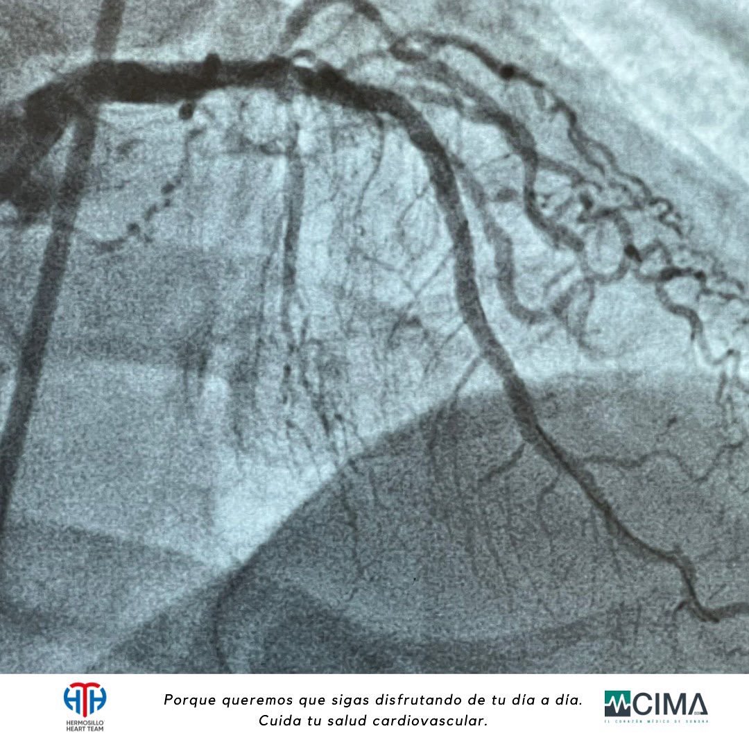 TeamHermosillo's tweet photo. #HermosilloHeartTeam y #HospitalCIMAhermosillo Una vez más haciendo historia en el Noroeste como primer centro donde se realiza litoplástia  Intercoronaria conocida en el idioma inglés como “Shock Wave”. Primeros en el #Noroeste en contar con esta tecnología. Solo en HHT-H.CIMA https://t.co/U29L6VLw8l
