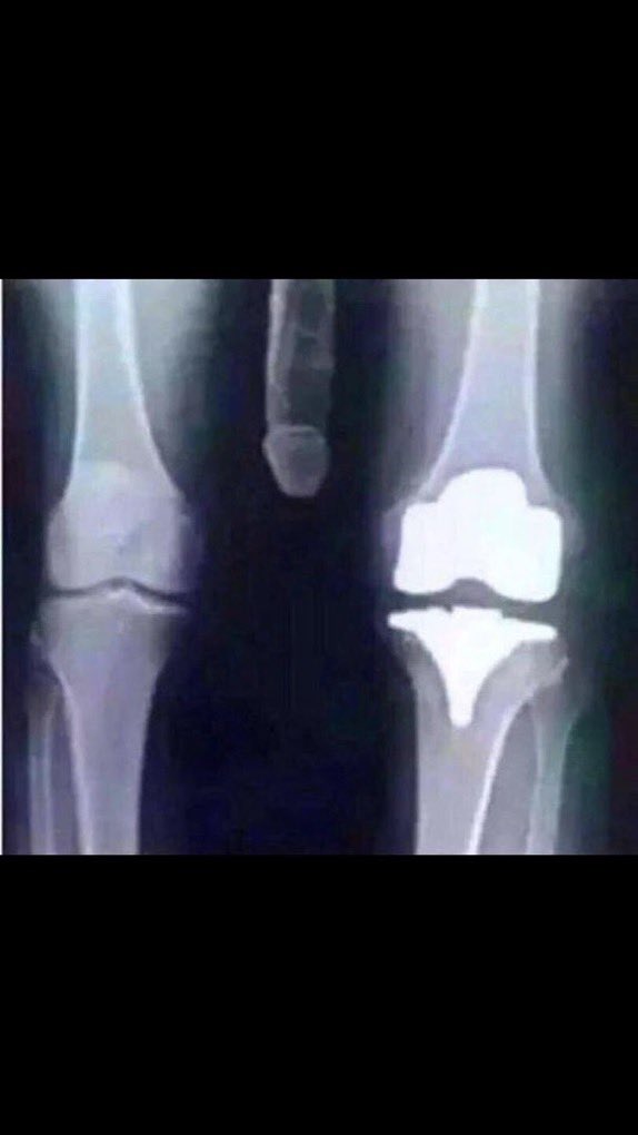 Compare the right knee with the left. 

Within two days of this BJJ injury (cruciate ligament) it completely healed.

Doctors were amazed. 

My secret?

I’m a superior human. 

Follow to learn more about how amazing I am.