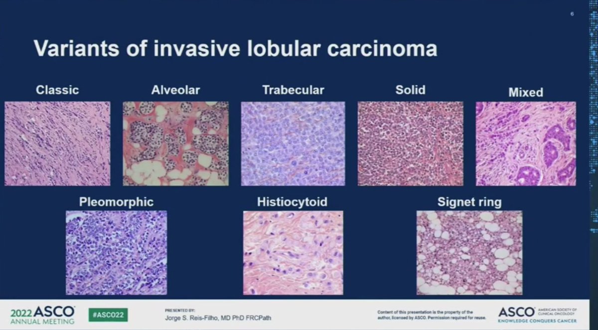 jackel626's tweet photo. Jorge Chis-Filho @MSKCancerCenter, LBCA SAB member on the unique pathology, biology and genomics of #lobular and rare types of lobular breast cancer #TNBC @LobularBCA #ASCO22 #bcsm https://t.co/HjR5b1FWP2