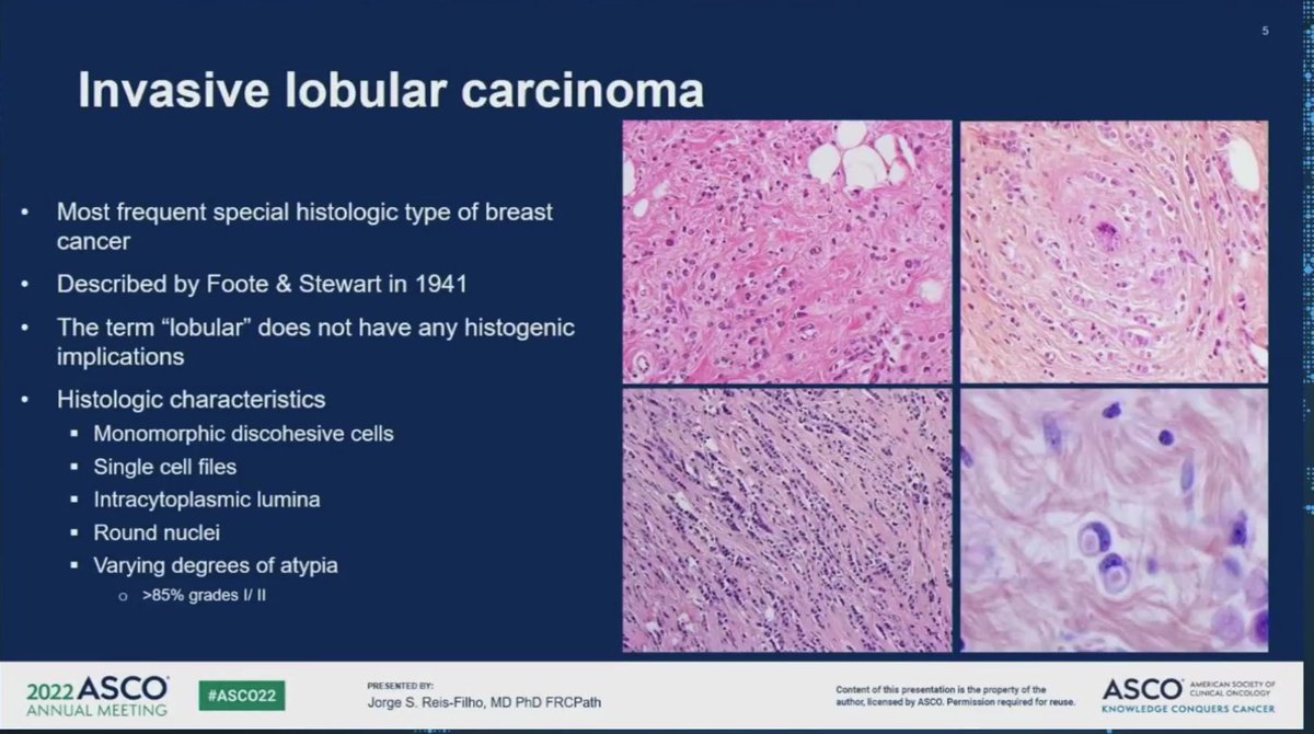 jackel626's tweet photo. Jorge Chis-Filho @MSKCancerCenter, LBCA SAB member on the unique pathology, biology and genomics of #lobular and rare types of lobular breast cancer #TNBC @LobularBCA #ASCO22 #bcsm https://t.co/HjR5b1FWP2