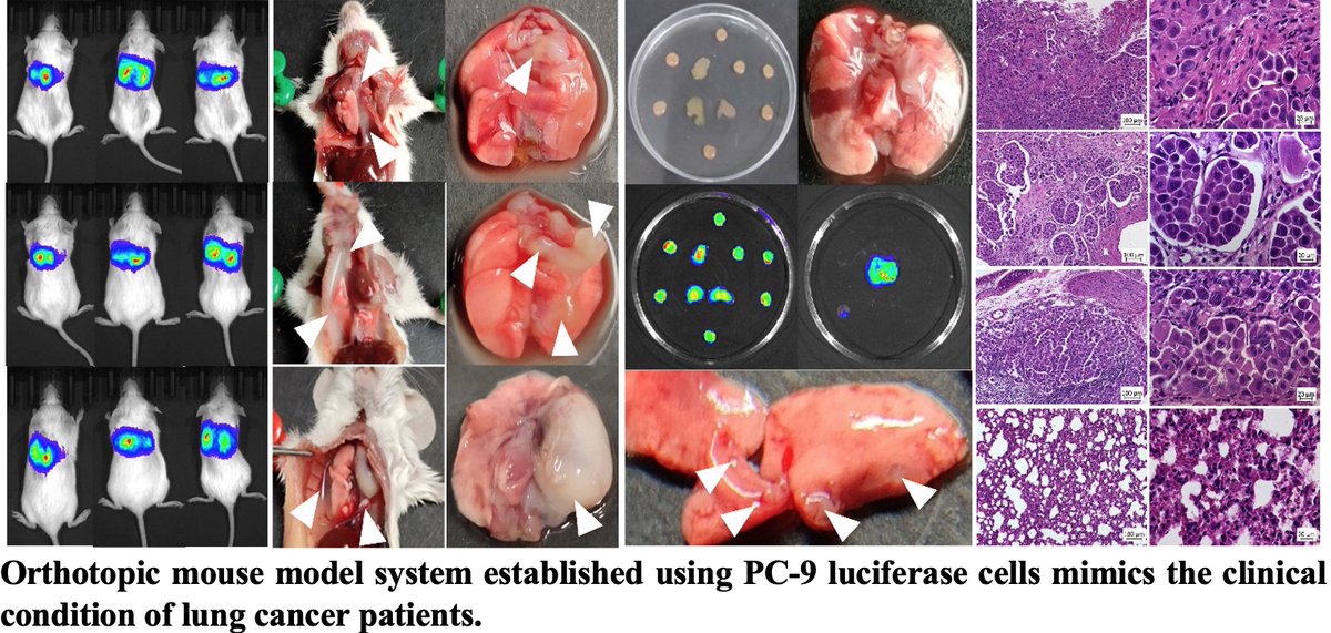 Amit Dutt (@amtdutt) on Twitter photo Pleased to share a clinically relevant finding by Asim Joshi and Ashwin Butle from the lab with Kumar Prabhash and <a href="/VanitaNoronha/">Vanita Noronha, MBBS MD DM</a> from TMH. Osimertinib for lung cancer cells harboring low-frequency EGFR T790M mutation. Thank you <a href="/serbonline/">SERB</a> for the funding.sciencedirect.com/science/articl… Pleased to share a clinically relevant finding by Asim Joshi and Ashwin Butle from the lab with Kumar Prabhash and <a href="/VanitaNoronha/">Vanita Noronha, MBBS MD DM</a> from TMH. Osimertinib for lung cancer cells harboring low-frequency EGFR T790M mutation. Thank you <a href="/serbonline/">SERB</a> for the funding.sciencedirect.com/science/articl…