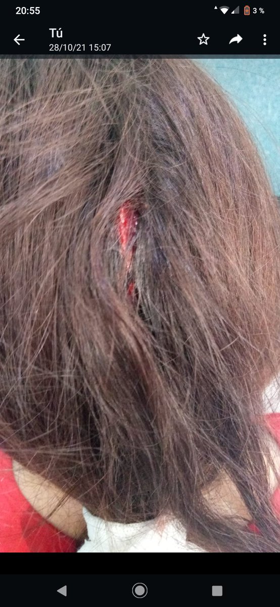Yanelit09's tweet photo. @Kicillofok Así le quedó la cabeza a mí hija cuando, sentada copiando tarea, se le cayó una ventana q estaba a 3mts de altura y tiene 136 años. Escuela 5 de bahía blanca. La cuenta porque tiene un dios aparte. Sigo esperando presupuesto para q arreglen lo que prometieron https://t.co/YjazINOatB