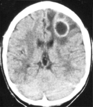 Lupus + Immunosuppression + Ring enhancing Lesions on image

▶️▶️🧠Primary Central Nervous System Lymphoma (PCNSL) should be considered wikem.org/wiki/Ring-enha…