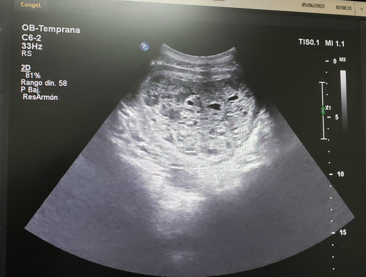 Como cuando te mandan una amenaza de aborto de 11 semanas y ves esto 🙄🙄 😅🥲