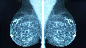 La_SER's tweet photo. 🔴Un nuevo y esperanzador fármaco dobla la supervivencia en pacientes con cáncer de mama metastásico

https://t.co/hrCnJXdWb2 https://t.co/cPoLbxkHfP