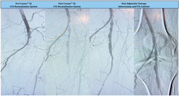 RobRighi's tweet photo. Diseased fem pop + anterior tibial artery. Observed a 1 min 48 sec activation time to cross a 22cm CTO using #CrosseriQ catheter. Great results by Dr. Park! #CrossThisFast
For use in peripheral artery CTOs; Not for use in carotid arteries. Safety info: https://t.co/fJWqHkkPSc https://t.co/ztW9wZPGcK