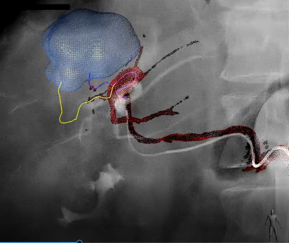 RadiologiaRyc's tweet photo. Single step HCC  RF+TACE treatment at Ramon y Cajal Interventional Unit.
58yr-old HVC chronic liver disease, 40mm HCC. Central location and direct contact with SHV.Too large for RF alone and too young for a palliative TACE alone.
CBCT+Emboguide DEBTACE and RF w IMACTIS navigation https://t.co/nXZNoc0xQI