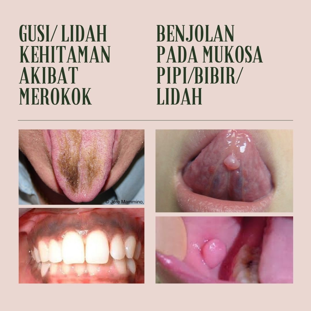 paramardhikaxvr's tweet photo. Halo! Saya Asti, koas kedokteran gigi.

Kalau anda/keluarga/teman/kenalan anda memiliki keluhan gigi dan mulut seperti di gambar dapat menghubungi saya melalui DM! 😉 https://t.co/wInHYDNZkK
