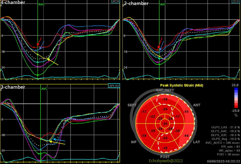 echobyweb's tweet image. A case of apparent normal (global) longitudinal strain in a patient with occluded LAD. Follow the link to the images: echobyweb.com/apparently-nor…
#CardioTwitter #cvImaging #cvEcho #echofirst #cardiology #CAD #strain