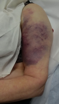 Ohne dienstlichen Grund gab ein Unteroffizier einem Obergefreiten den Befehl „Stillgestanden!" und kniff ihm dann mehrfach in die Oberarme, wodurch sich zwei größere Blutergüsse bildeten.