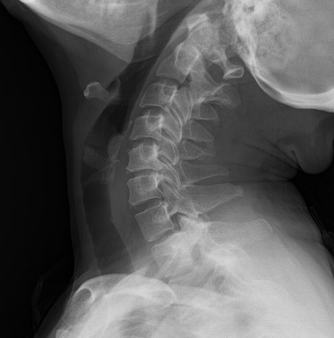 BerivanBitikMD's tweet photo. #RheumCases 50,F, AS HLA B27+, sulfasalazine 1+2 pill/day, ESR CRP normal, no complaints other than mechanical headache radiating from the neck No inflammation on cervical MRI.  received FTR  and NSAIdsfor disc herniation no dramatic response. Plan?🧐 anti tnf? https://t.co/mCNRFTWGNH
