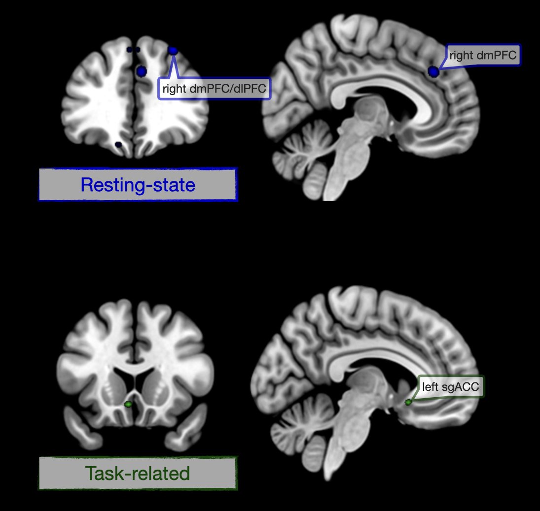 First meta-analysis on the neural correlates of peripartum depression. Meet me at the virtual poster tomorrow or in two weeks in Glasgow at #OHBM2022, if you want to know more. Great work led by <a href="/raquelg_18/">Raquel Guiomar</a> <a href="/RiseupPPD/">Riseup-PPD</a>