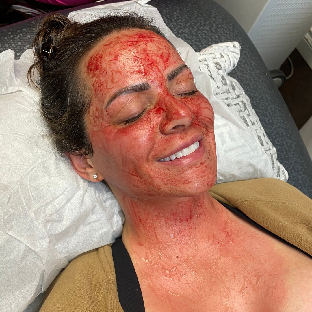 skinperfectmed's tweet photo. #Microneedling + Exosomes = Skin perfect 💉 Our patient started coming to us every 6 months to improve her skin texture, quality and to reduce the appearance of scarring on her face 💕 Also don't panic - this may look gory but she can't feel much at all (thank you Lidocaine!) 😍 https://t.co/i4fCLskzEn