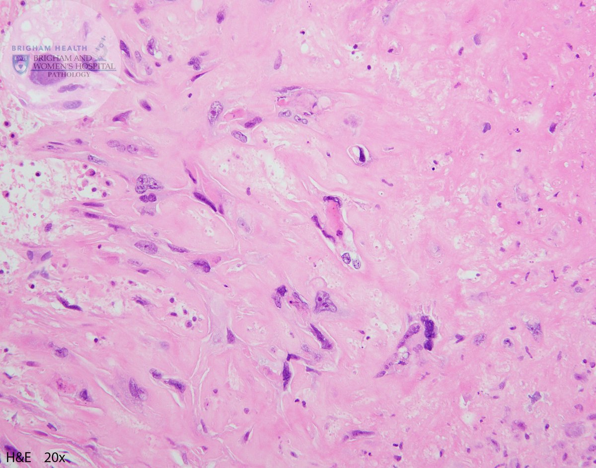 BWHPath's tweet photo. 1st case is a D&amp;E in a woman with elevated serum HCG. H&amp;E shows blunt-tipped branching edematous villi, degenerating villous mesenchymal cells. Villous trophoblast atypia is most pronounced at implantation site. Diagnosis? #BWHPathCotW  #BWHGynPathSummer #Pathology #GYNPath https://t.co/BTprx34VmE