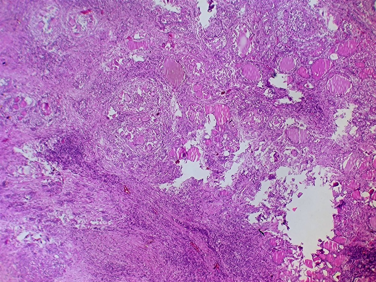 RaulcastrejonR's tweet photo. Subacute Granulomatous Thyroiditis (de Quervain) #thyroidpathology #Pathology https://t.co/L9OLO4aBzJ