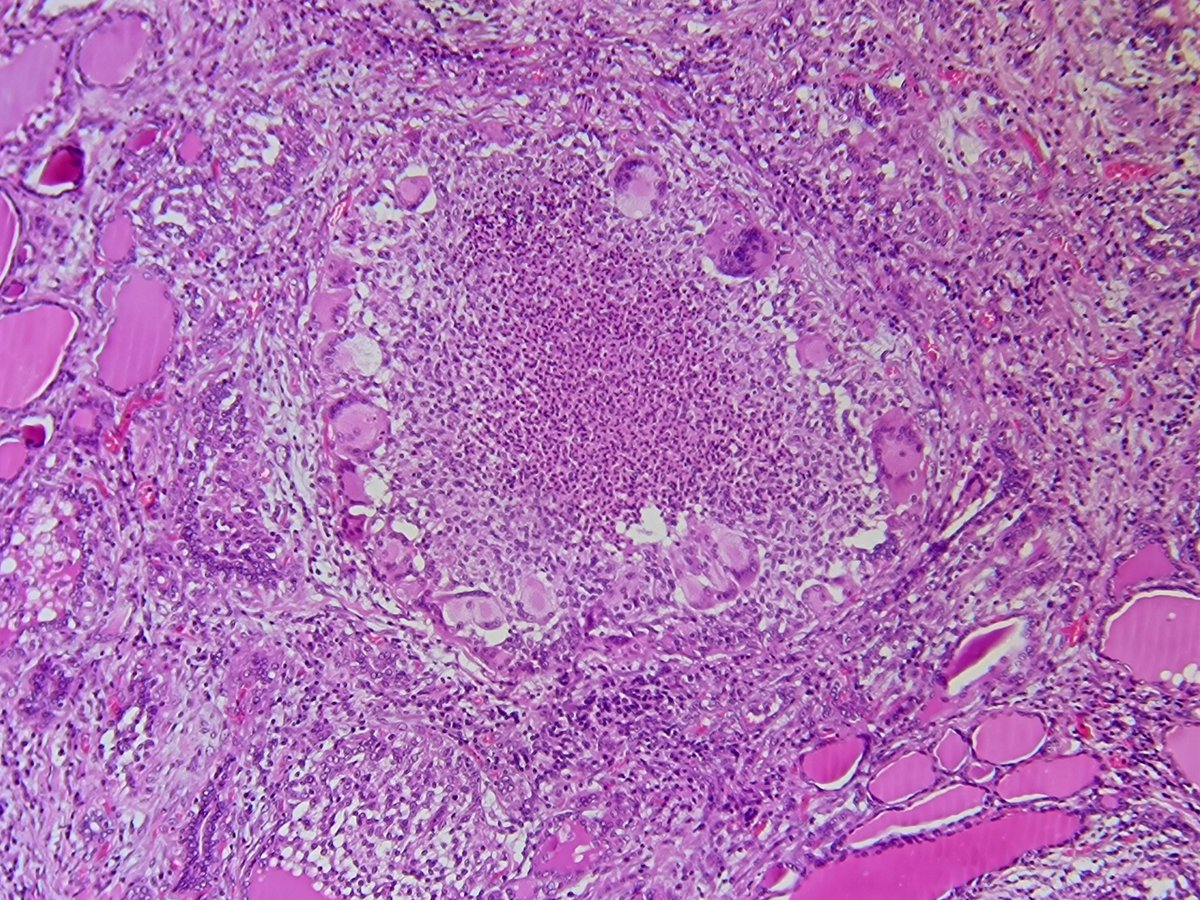 RaulcastrejonR's tweet photo. Subacute Granulomatous Thyroiditis (de Quervain) #thyroidpathology #Pathology https://t.co/L9OLO4aBzJ