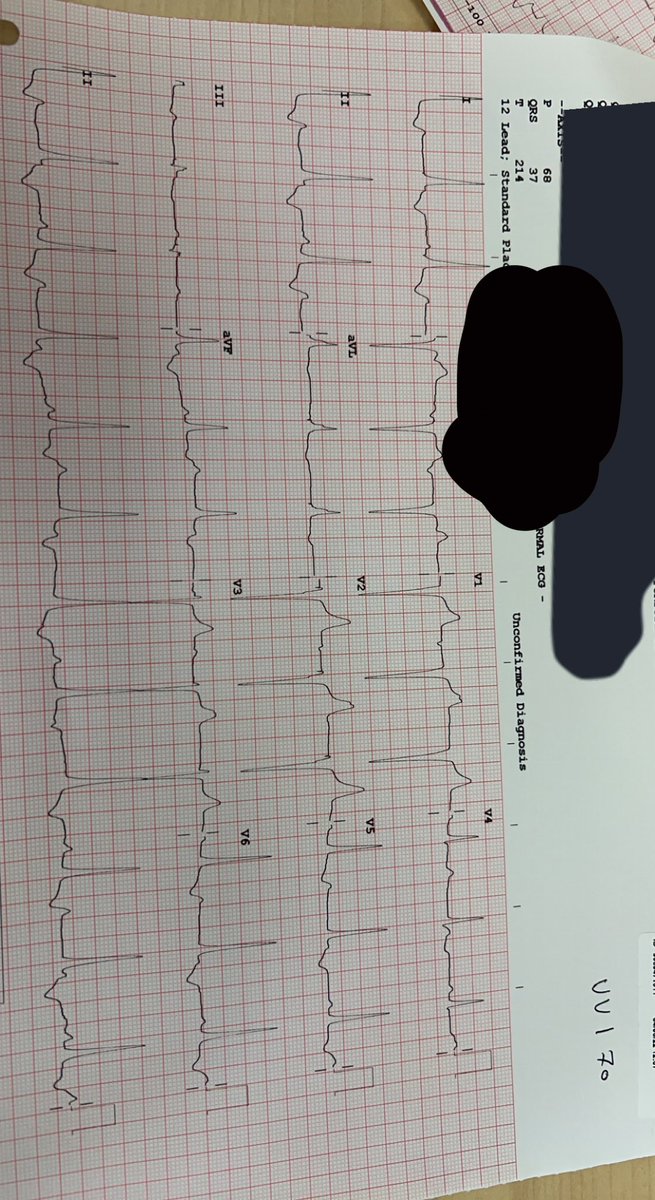 Today we did another his bundle pacing using the #Medtronic kit. 

By Using the analyzer we can see the AHV as senesed event and pacing we will see narrow signal EGM and ECG narrow QRS. 

Or using EP system to see more clear signals.
 #his_bundle_pacing
#Epeeps