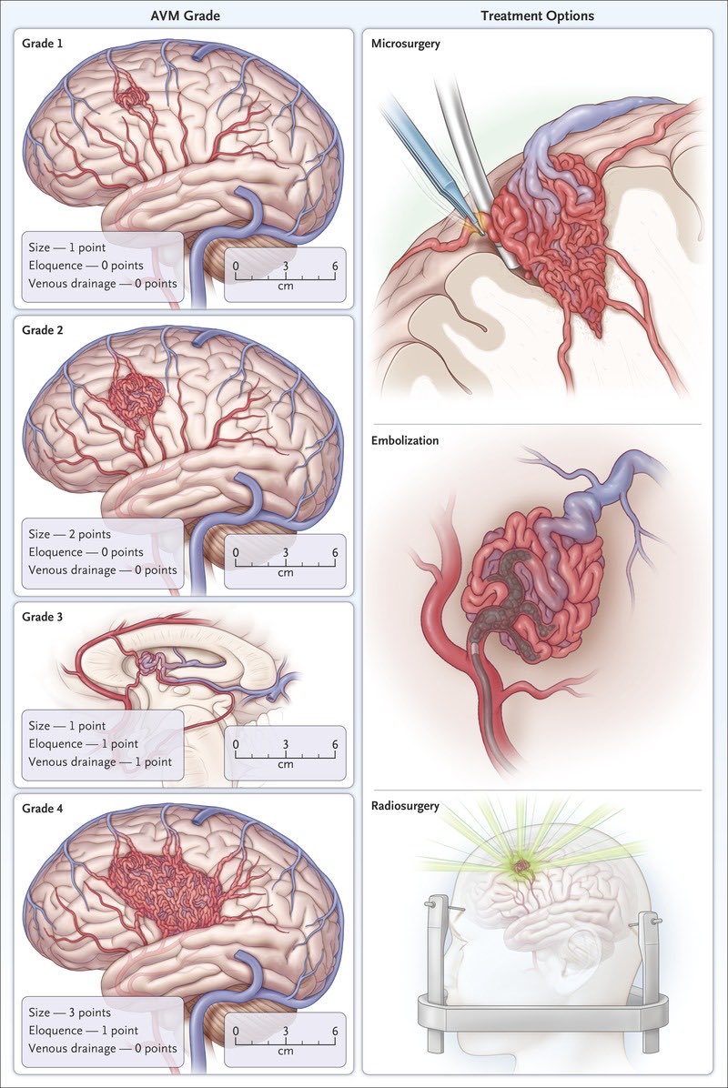 OGdukeneurosurg's tweet photo. How’s your knowledge of cerebral AVMs? Learn the primary historical grading scale and treatment options. Btw, scale goes up to 5.  For extra credit, read up on ARUBA trial and latest literature. https://t.co/nSEcxhciTX