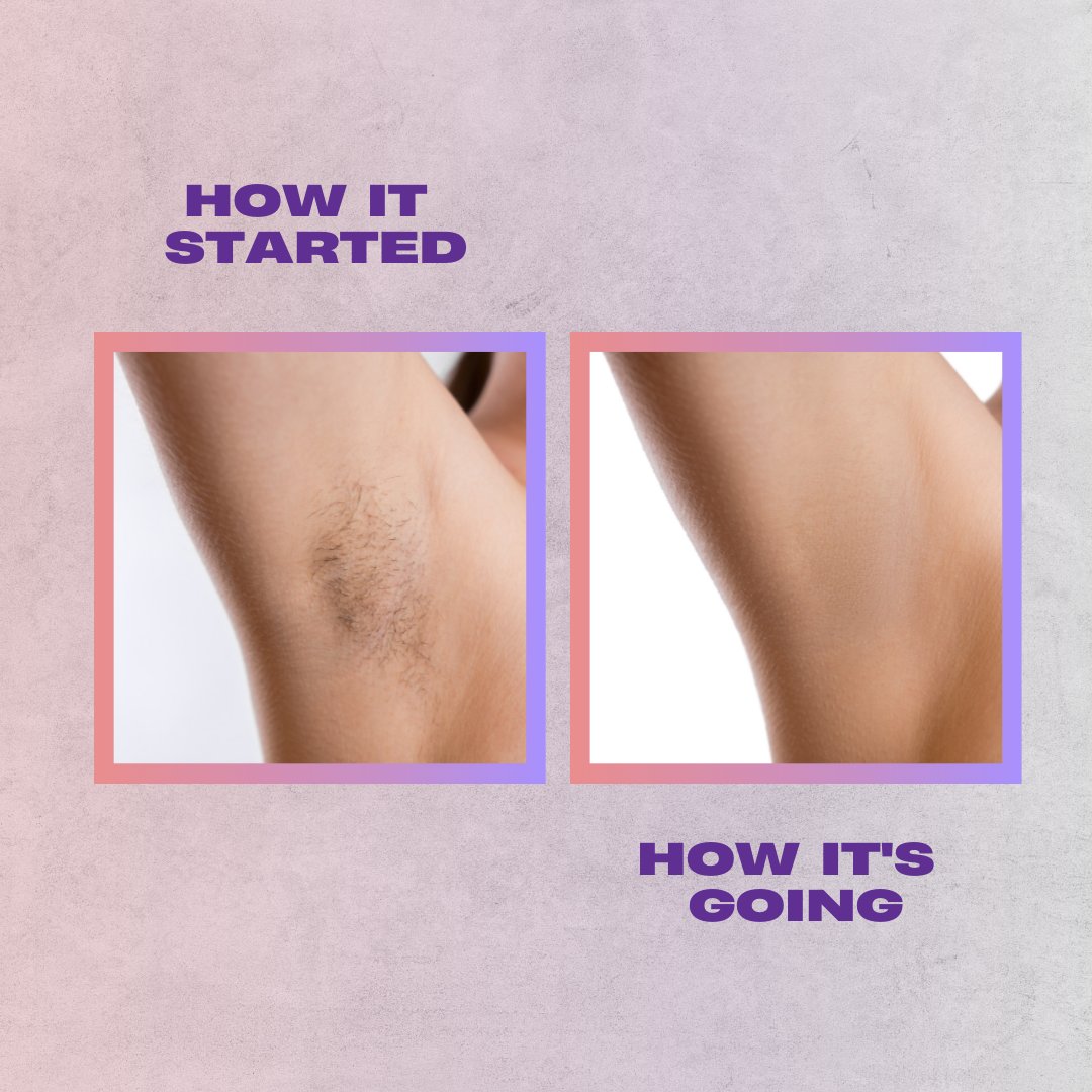 anabellswaxing's tweet photo. We love seeing results!
.
#brazilianwax #waxing #wax #hairremoval #spa #snellvillega #vajacial #vsteam #snellville #loveyourself #betteryou #divine #selfcare https://t.co/0kHFQdi4bw