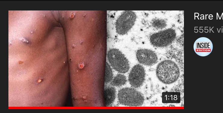 Todays Tweet/Thread:
-Neo Colonialism
-Racial Subliminal Messaging 
-The Caucasian eco chamber

Came across Inside Editions vid on monkey pox, quickly noticed its use of this black man as a thumbnail, the virus having been recently identified in a mainly Caucasian demographic atm