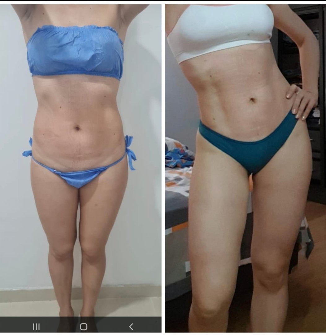 andresrivera23's tweet photo. En Natycosmetologa tenemos estos excelentes resultados. Tratamiento reductor con marcación abdominal y definición de cintura 😉😉😉. Más información al WhatsApp 📱3003892697. Síguenos en instagram como 👉🏽Natycosmetologa. https://t.co/5zJsspv2Tx