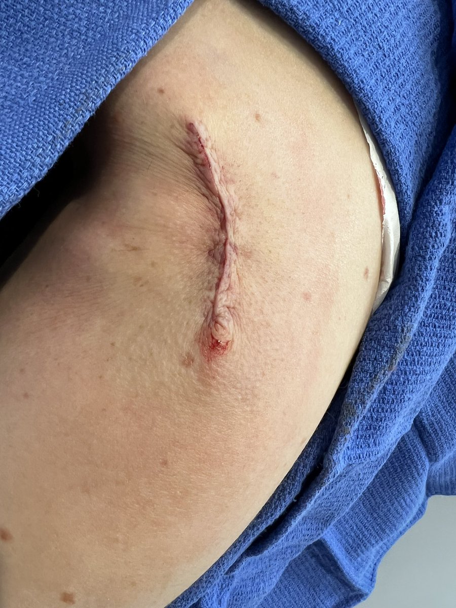 sharmanian's tweet photo. Just had a very early stage skin melanoma cut out. Should be zero issue except a higher risk of future skin cancer, which will be monitored closely. A good reminder for runners of any age (since this was partially due to sunburn as a kid) - cover your skin and wear sunscreen. https://t.co/oAzLDSBJYp