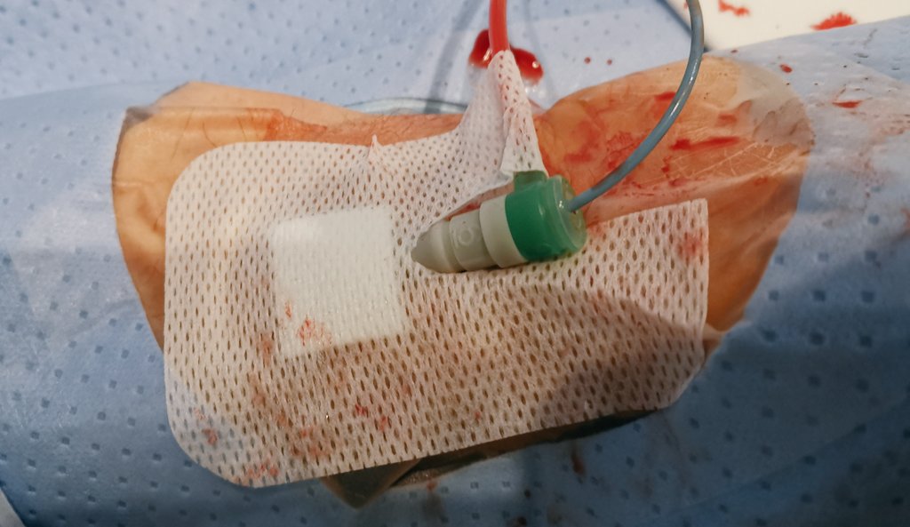 Easy #tips&tricks in CathLab. Terumo #Glidesheath Slender easy slips out of radial artery. Inserting it back is not always easy Using one wing of dressing for securing cannulas fix it and you can forget problem #PCI #radialaccess