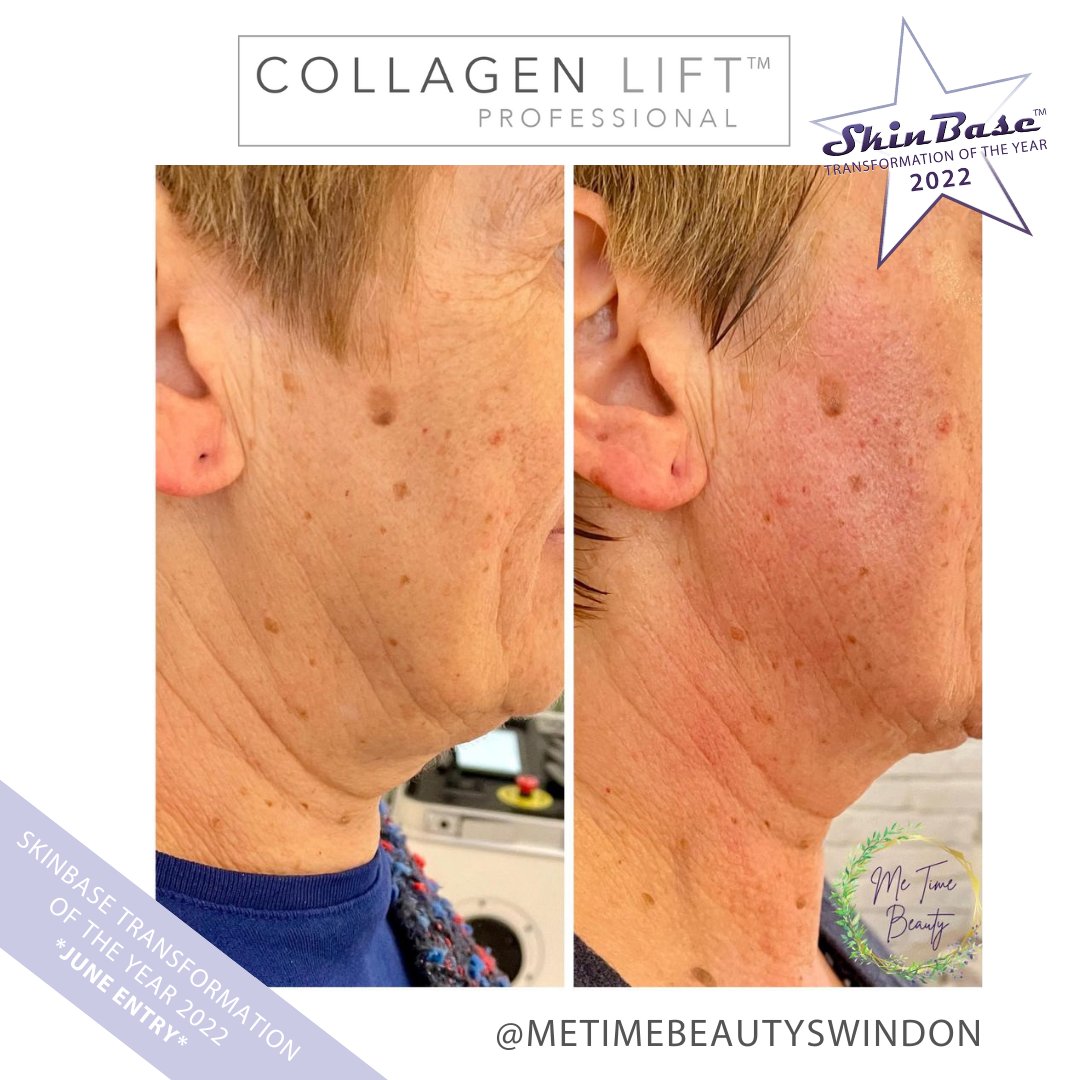 SkinBase_facial's tweet image. ⭐️ June transformation with this fabulous entry from Me Time Beauty.

These fantastic results were achieved through a 5 treatment course of Collagen Lift.  

Click the link in our bio for your chance to Win a Holiday! #skinbase #collagenlift #transformation22