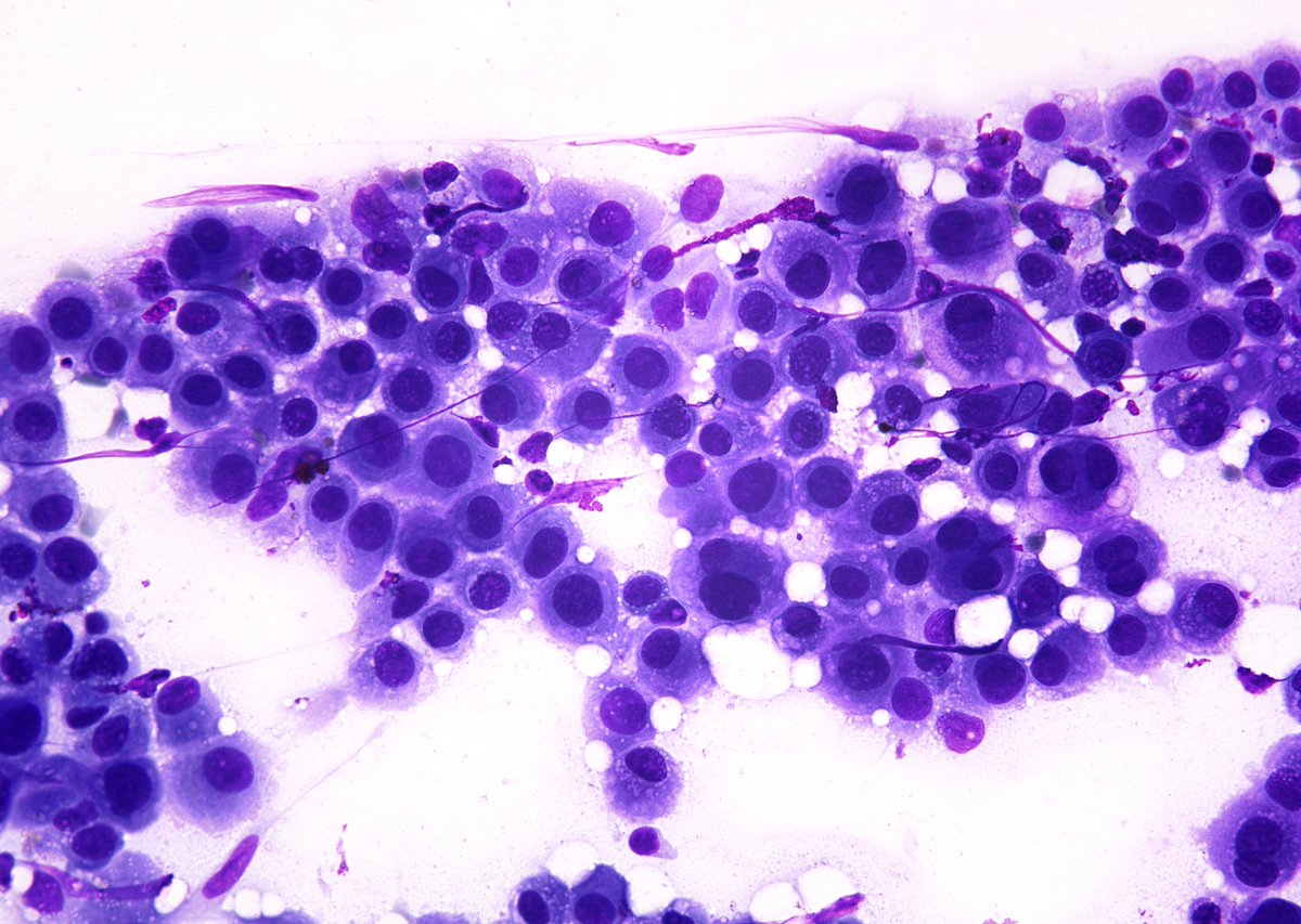 sza_jhcyto's tweet photo. NOT a metastatic carcinoma in this internal mammary lymph node of a 59/F. The patient had a history of asbestos exposure and the findings are consistent with a metastatic "Mesothelioma" (confirmed by IHCs). (FNA) https://t.co/i5tpthO65D