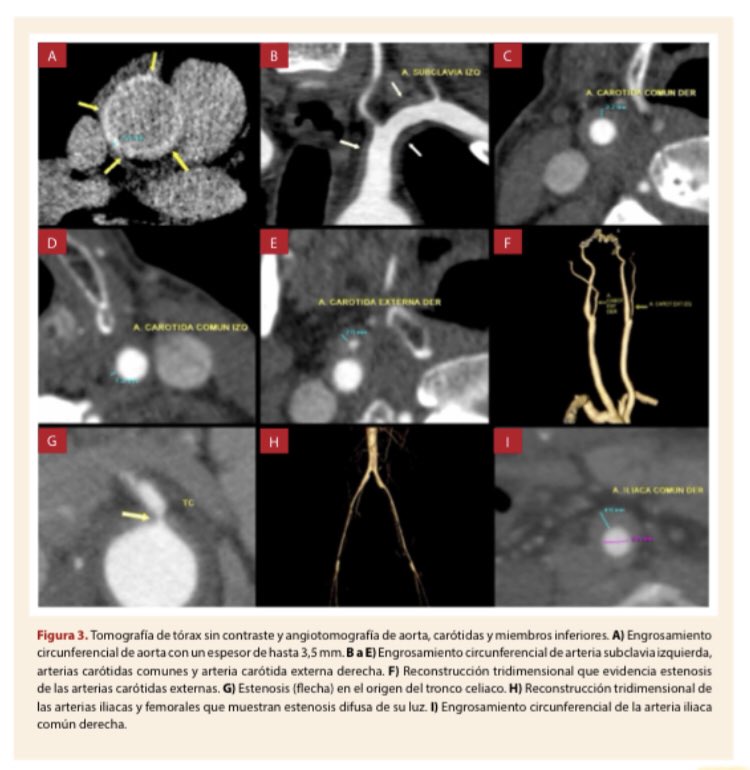 APCyCCV's tweet photo. ⚠️Y si NO todo es ateroesclerosis⁉️

👀Arteritis como causa inicial, en quien sospechó? 
💔En que momento revascularizar, cuál es el pronóstico?

Aquí este interesante caso clínico
⬇️

https://t.co/iqerWc14uH https://t.co/eUOitS05uE