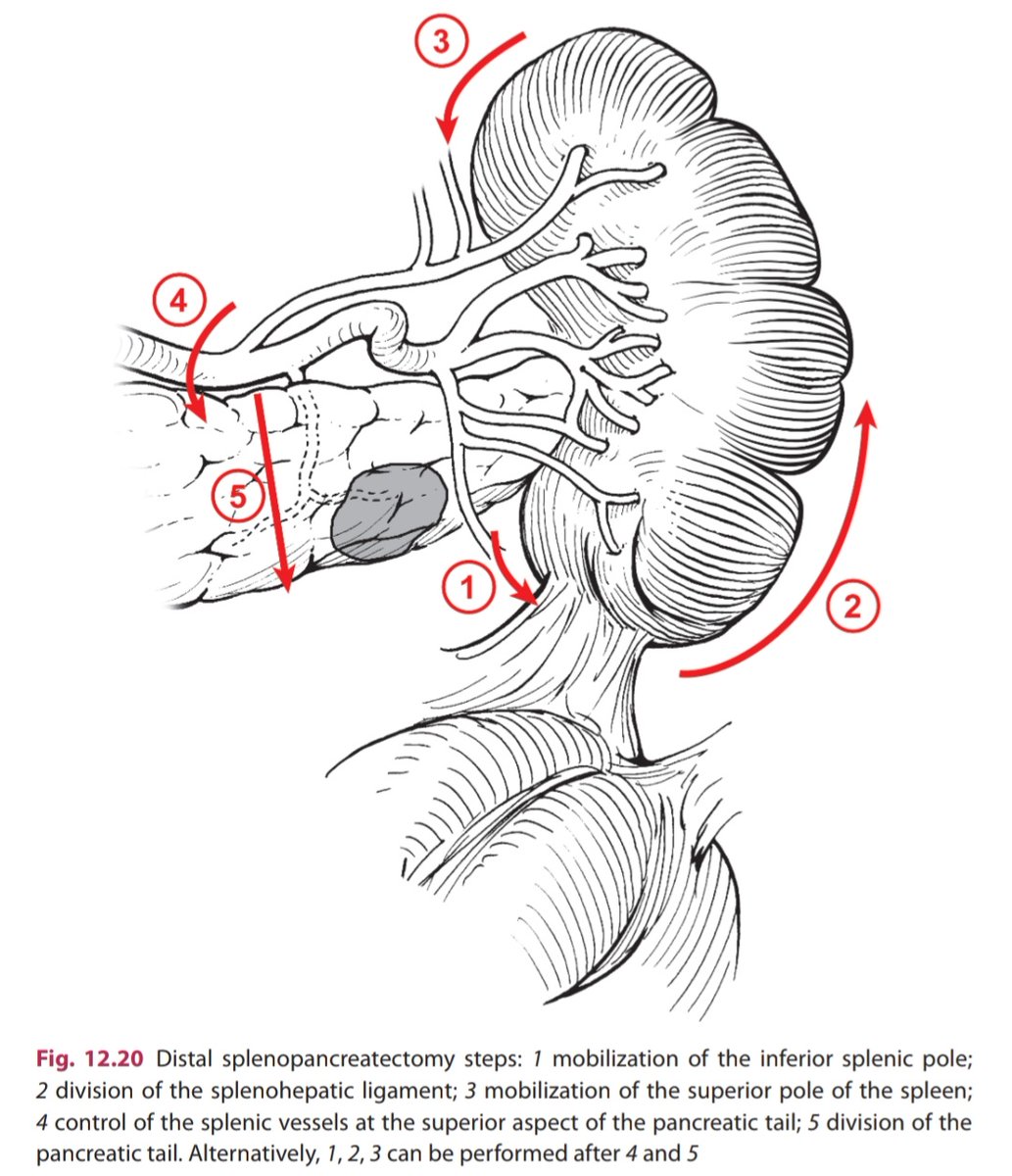 DRAFTABAHMED7's tweet image. Distal splenopancreatectomy Steps
#MedTwitter #GITwitter #splenectomy #pancreaticobiliary