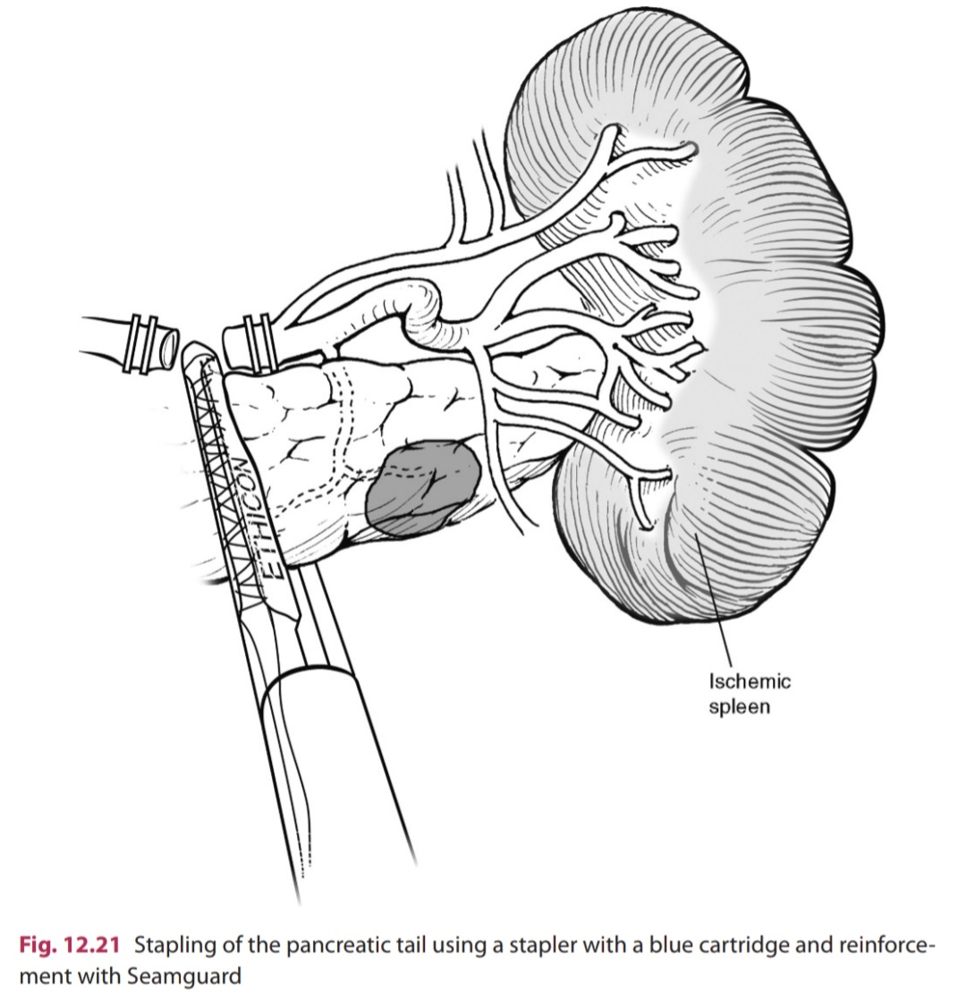 DRAFTABAHMED7's tweet image. Distal splenopancreatectomy Steps
#MedTwitter #GITwitter #splenectomy #pancreaticobiliary