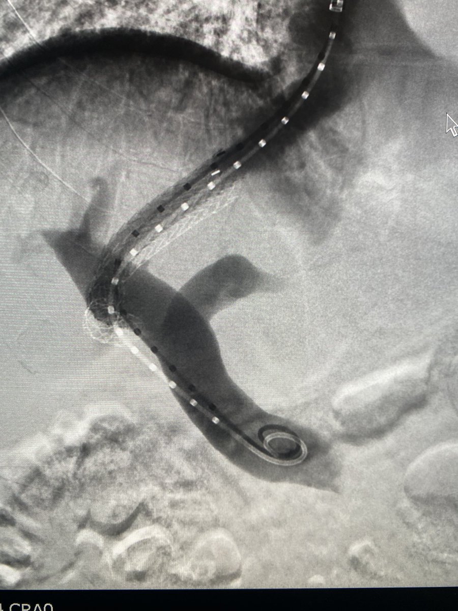 Back to back TIPS on a Thursday afternoon. First use of recent Health Canada approved Argon Medical Scorpion X TIPS needle. First case 48 min, second case 65 min. Seems good so far!!
#irad #twittIR <a href="/SIRspecialists/">Society of Interventional Radiology</a> <a href="/CAIRweb/">Canadian Association for Interventional Radiology</a> <a href="/CAIRrfs/">CAIR Resident, Fellow, Student Section</a>