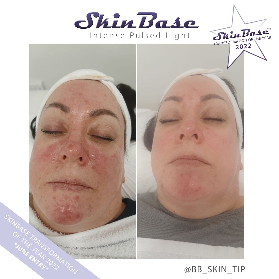 SkinBase_facial's tweet image. ⭐️ June transformation with this fabulous entry from Skin Tip

These fantastic results were achieved through a 6 treatment course of IPL Advanced.  

Click the link in our bio for your chance to Win a Holiday! #skinbase #skinbaseipl #transformation22