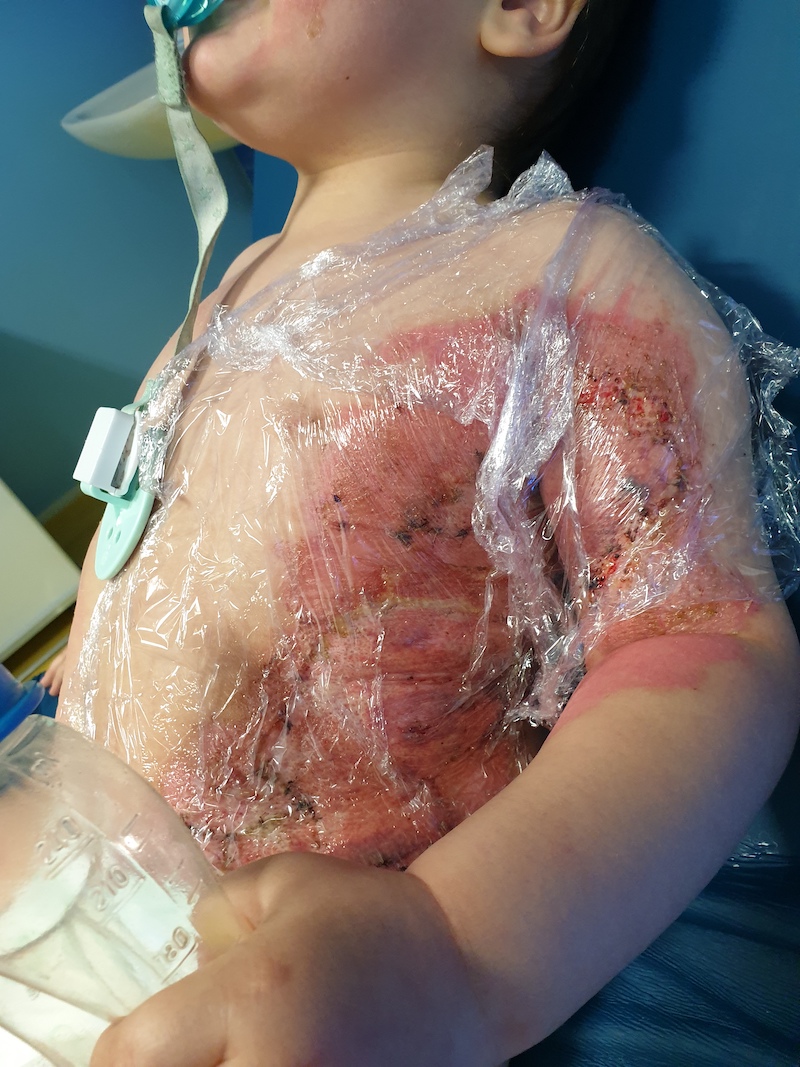 ChildrensBurnsTrust tweet media