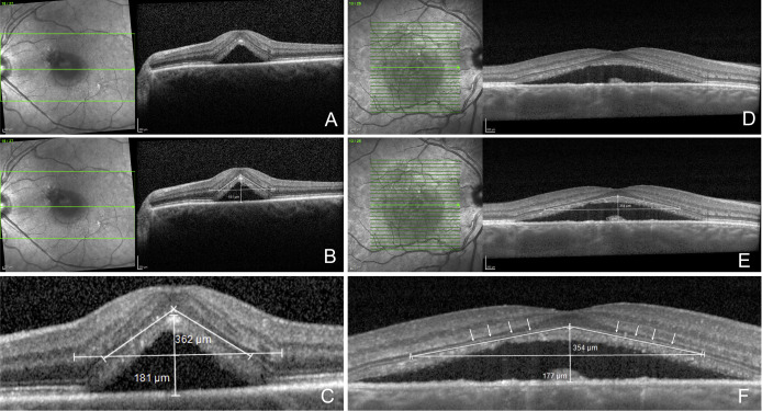 This study provides a novel morphological feature on OCT, called 'the Fuji sign', which can be helpful to discern cCSC patients with a higher change of spontaneous SRF resolution without treatment. ow.ly/8iBj50J8V6Y