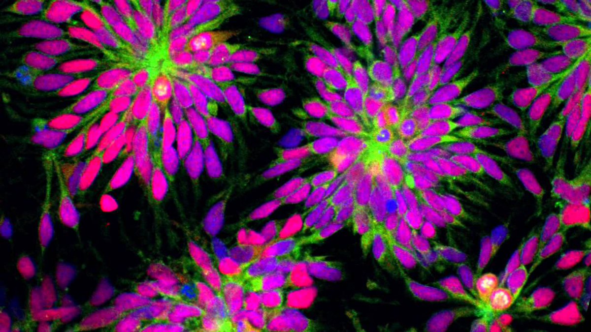 This is a beautiful image of human brain cells, which can now be grown from adult skin cells.

Source: <a href="/Cambridge_Uni/">Cambridge University</a> 

#neuroscience #NeuroTwitter #MedTwitter #Science #biology