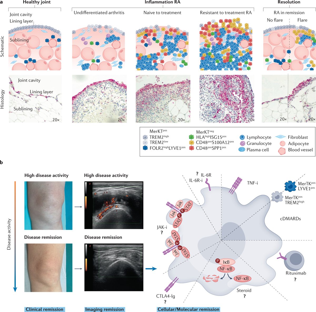 Very glad to share the review written with <a href="/DrMariola/">Prof Mariola Kurowska-Stolarska lab</a> just released in <a href="/NatRevRheumatol/">NatRevRheumatol</a> on synovial tissue macrophage heterogeneity across the clinical trajectory of Rheumatoid Arthritis discussing their distinct roles as novel biomarkers and putative treatment targets.
