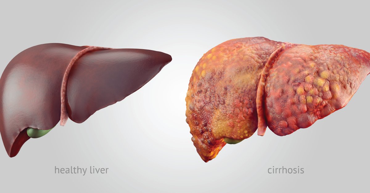 Drinking too much can make your liver swell and hold on to more fat. This could lead to cirrhosis. It typically happens if you drink more than you should every day, sometimes for years. wb.md/3zALAiv