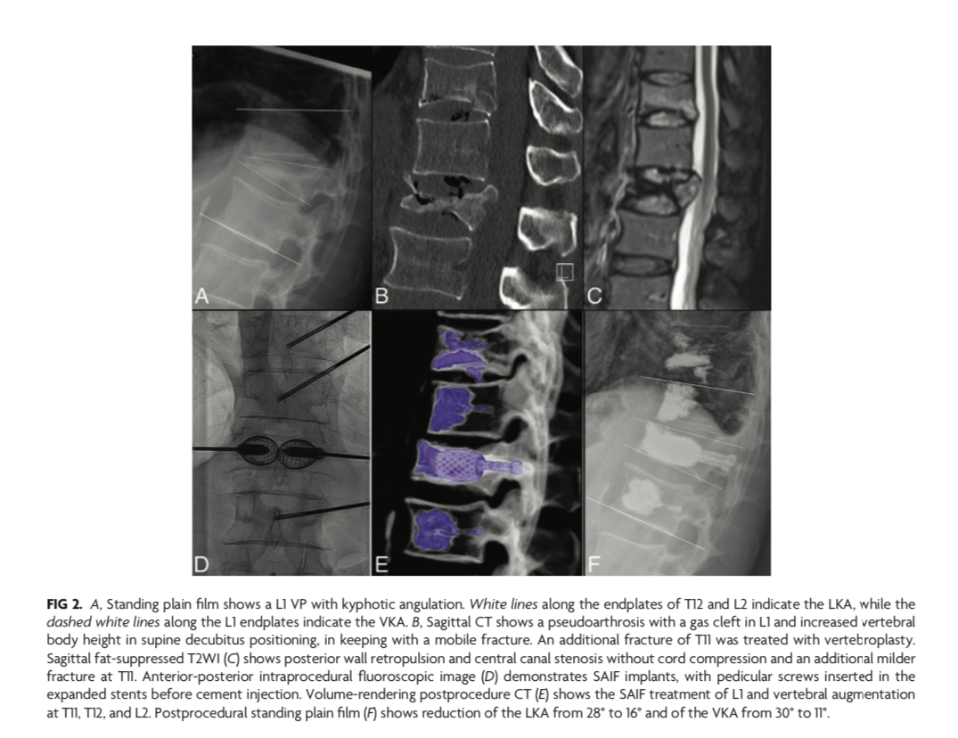 “Minimally Invasive Stent Screw–Assisted Internal Fixation Technique Corrects Kyphosis in Osteoporotic Vertebral Fractures with Severe Collapse: A Pilot “Vertebra Plana” Series”  #osteoporosis #FellowsJournalClub  <a href="/JoshuaAHirsch/">Josh Hirsch</a> <a href="/Marco_Pileggi/">Marco Pileggi</a> <a href="/The_ASSR/">American Society of Spine Radiology (ASSR)</a> | bit.ly/3tl63DZ