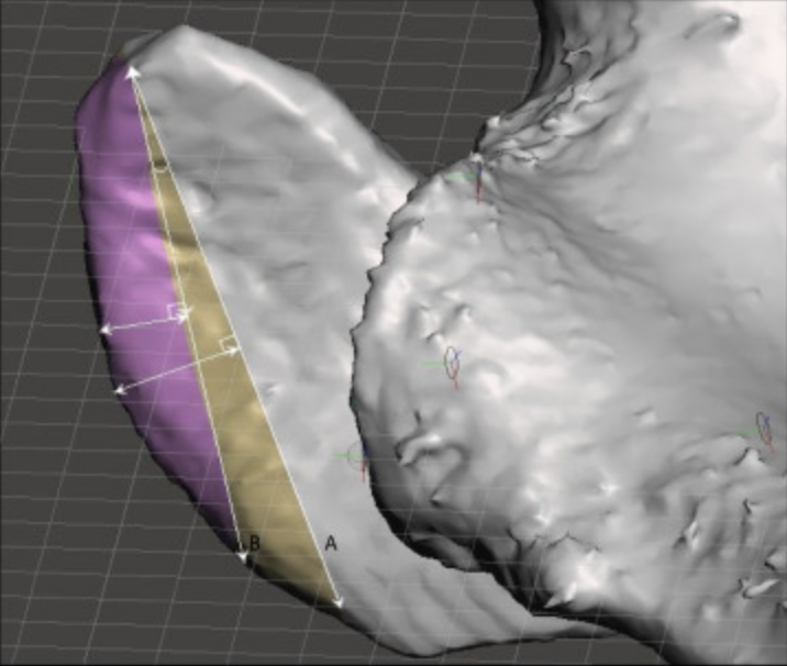 Open access! Lateral Acromioplasty With the Aim of Reducing the Critical Shoulder Angle Using Techniques Based on the Lateral Acromial Border Result in Larger-Than-Necessary Resections ow.ly/kjNG50Jq4Vl