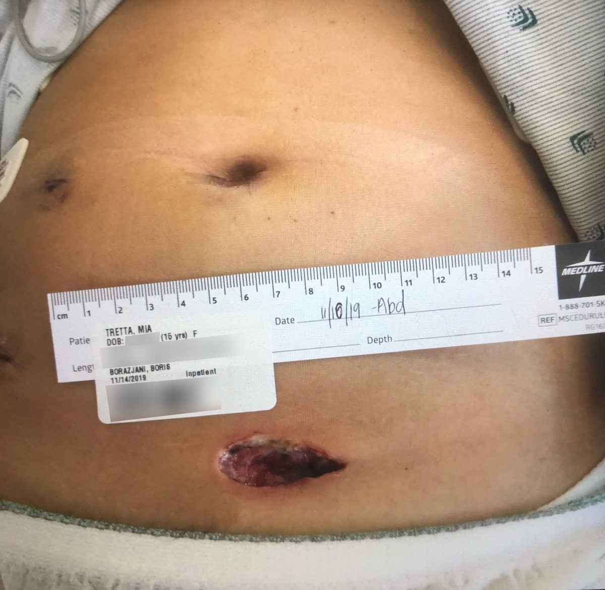 GUN VIOLENCE ISN’T PRETTY! This is the wound on my belly 2 days after i was shot by a .45 caliber ghost gun. I was 15 years old. #DontLookAway text BOLD to 644-33 to tell senate to ACT NOW before you have a picture like this of someone you love. #StudentsDemandAction #GunSaftey