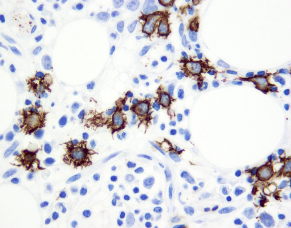FVega957's tweet photo. Cd20 showing "microvillous" DLBCL involving bone marrow. #lymphsm #hemapath I #lymphoma #lymsm https://t.co/fAbMaETYiV