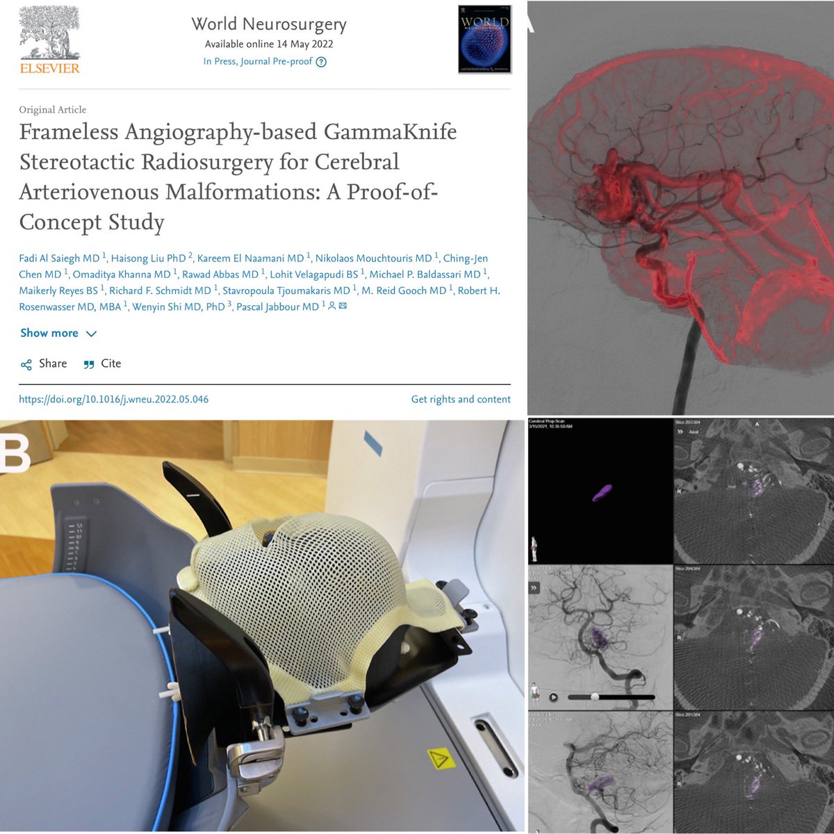 Pascal Jabbour MD, FAANS, FACS, FAHA (@pascaljabbourmd) on Twitter photo Innovation and cutting edge technology <a href="/TJUHNeurosurg/">Jefferson Neurosurgery</a> <a href="/JeffersonUniv/">Thomas Jefferson University</a> <a href="/TJUHospital/">Jefferson Health</a>. No need for a frame for angiography based Gamma knife treatment for AVMs with the new Elements software <a href="/Brainlab/">Brainlab</a> ,our feasibility study just published <a href="/WorldNeurosurg/">World Neurosurgery Journal</a> #gamma #AVM #frameless Innovation and cutting edge technology <a href="/TJUHNeurosurg/">Jefferson Neurosurgery</a> <a href="/JeffersonUniv/">Thomas Jefferson University</a> <a href="/TJUHospital/">Jefferson Health</a>. No need for a frame for angiography based Gamma knife treatment for AVMs with the new Elements software <a href="/Brainlab/">Brainlab</a> ,our feasibility study just published <a href="/WorldNeurosurg/">World Neurosurgery Journal</a> #gamma #AVM #frameless
